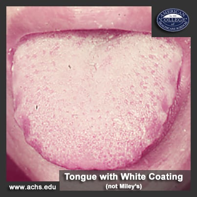 niacin deficiency tongue