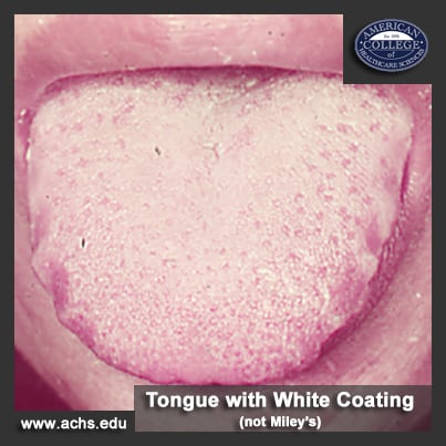 close-up image of a human tongue being stuck out of a mouth, the tongue has a white coating